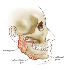 inflamed salivary ducts