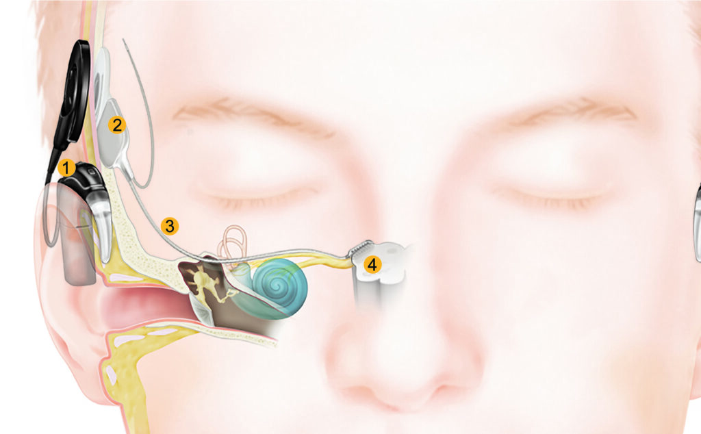 graphic showing how brainstem implant works