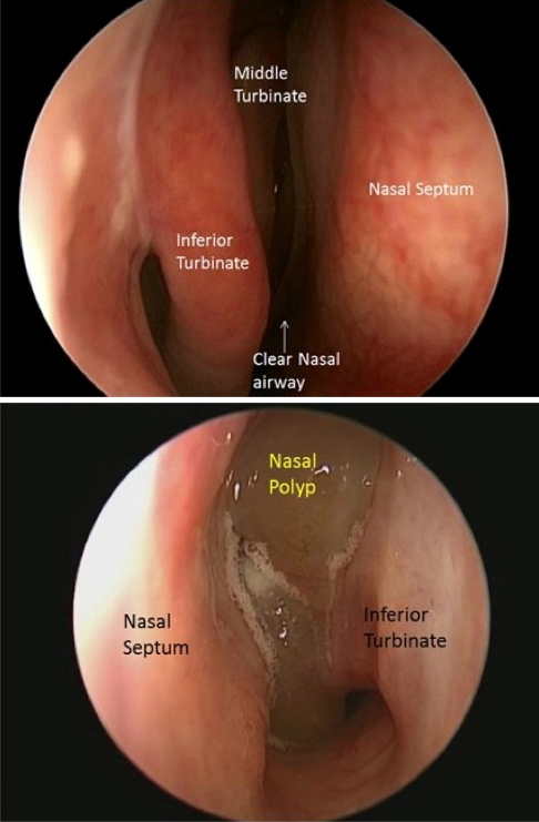 photo of nasal airway with polyp