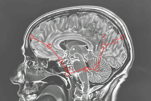 Can hearing loss predict Alzheimer’s disease?