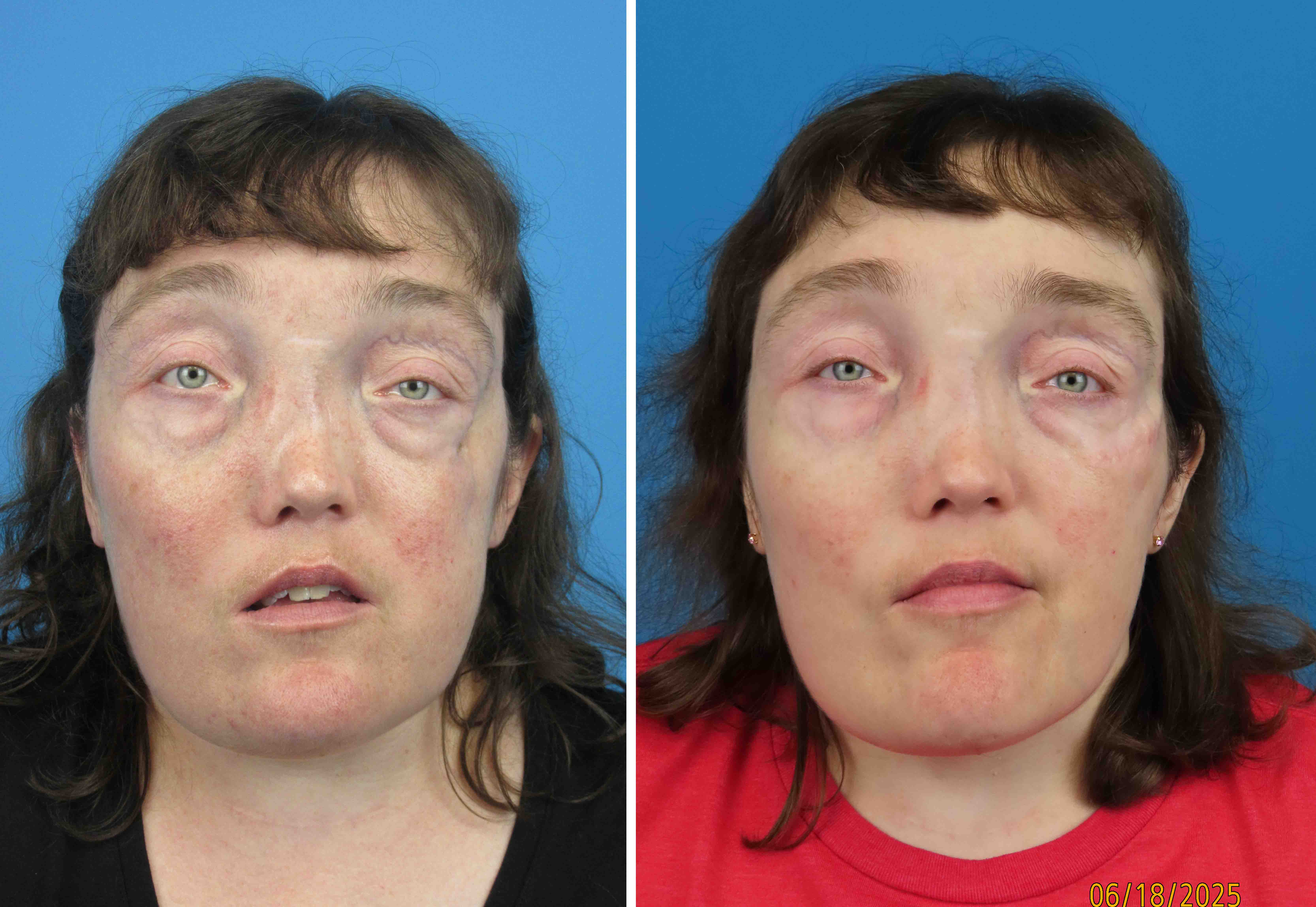 before/after photos of implant patient