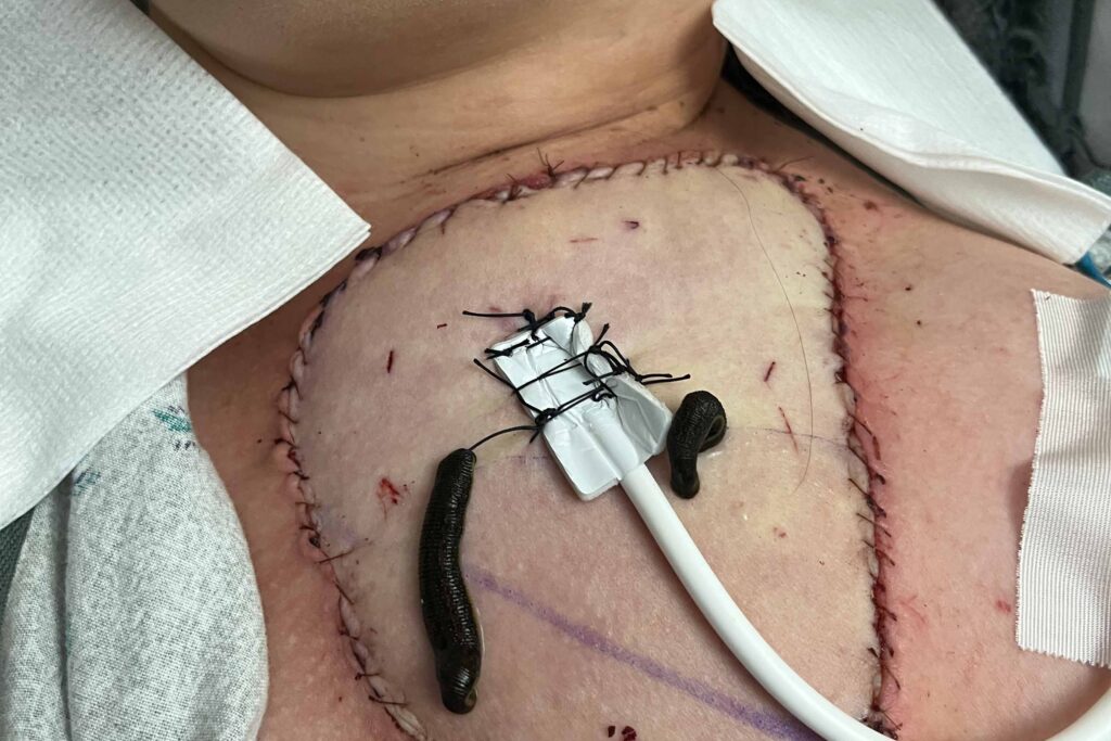photo of leeches
