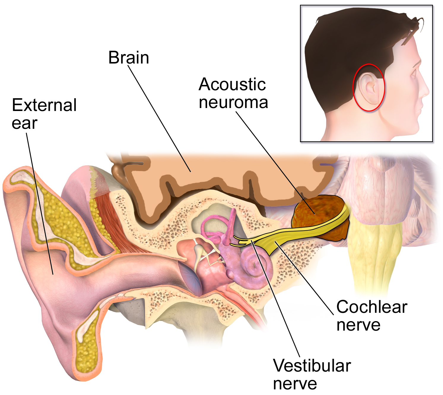 Acoustic Neuroma Otolaryngologyhead And Neck Surgery